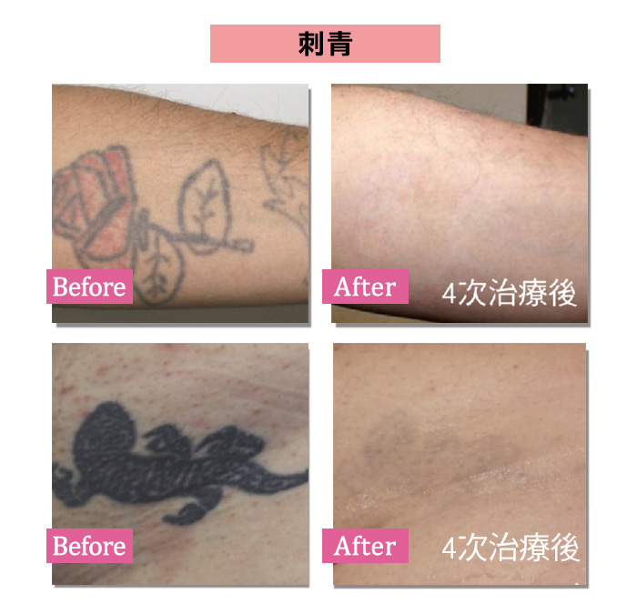 探索皮秒 刺青案例