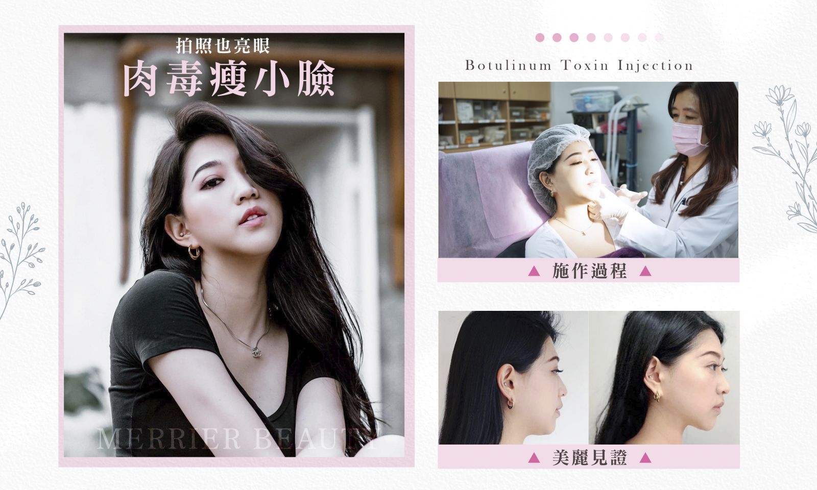 瑟芬 Sephine 音波拉提+肉毒瘦小臉FB