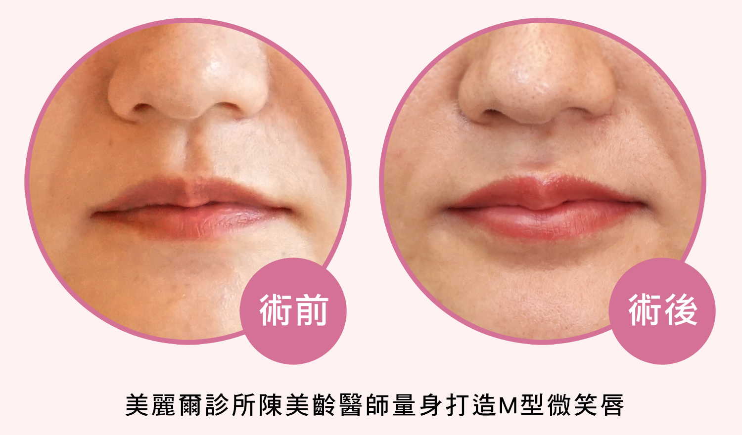Judy豐唇BA照