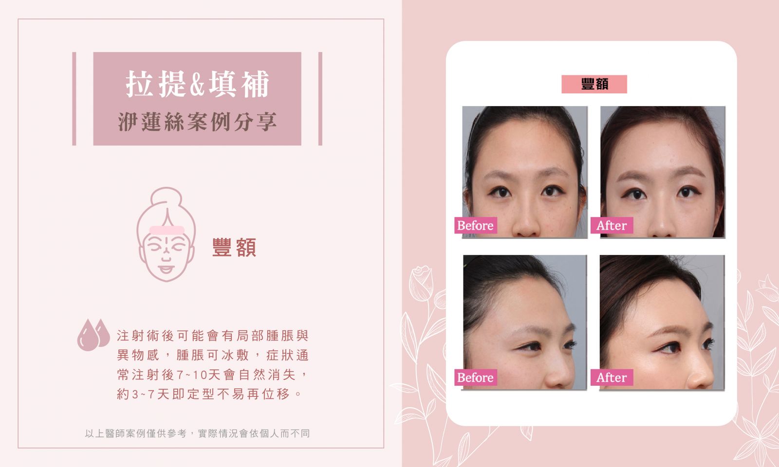 洢蓮絲BA_蘋果肌.額頭