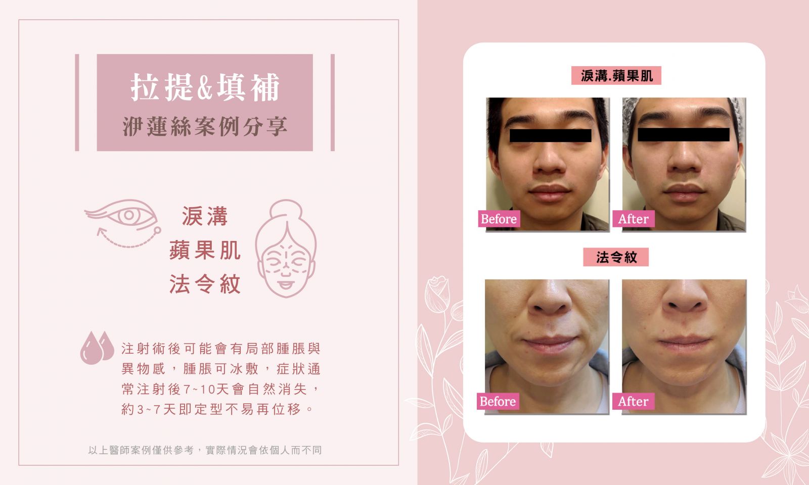 洢蓮絲BA_法令紋