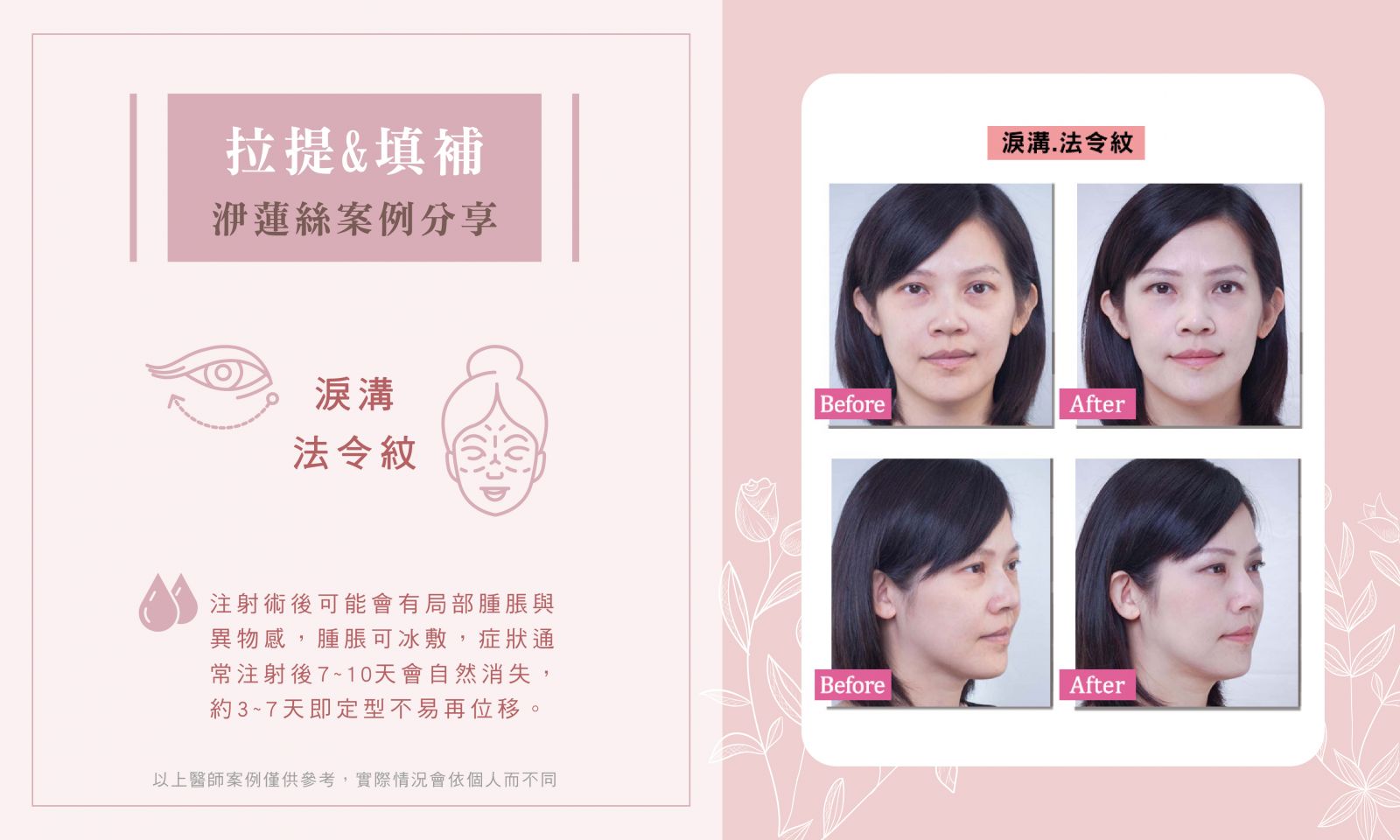洢蓮絲BA_淚溝.蘋果肌