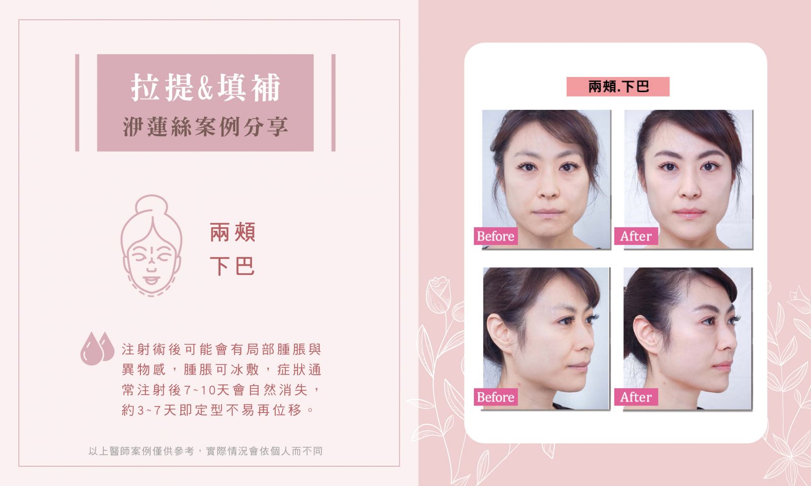 洢蓮絲BA_淚溝.法令紋