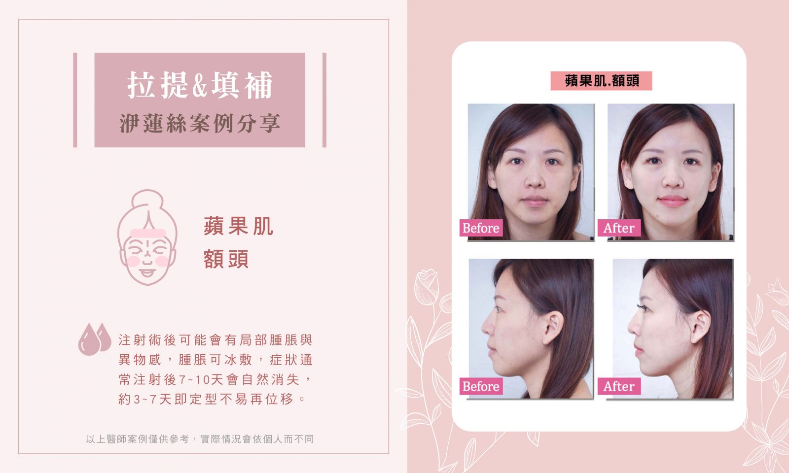 洢蓮絲BA_兩頰.下巴